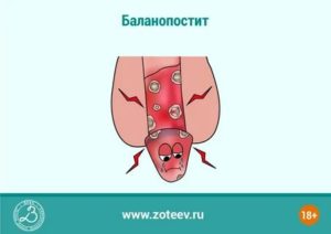 Ранки на уздечке при молочнице