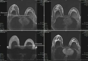 Мрт молочной железы с контрастированием в нижнем новгороде