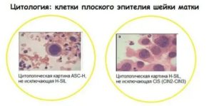 Дисплазия шейки матки цитологическое исследование