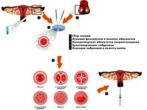 Как осуществляется сбор спермы