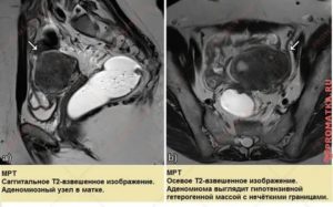 Признаки аденомиоза матки на мрт