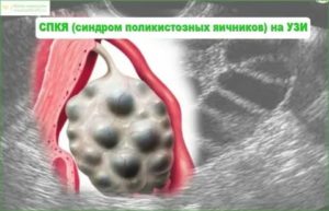 Как связаны щитовидная железа и поликистоз яичников