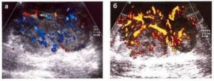 Кровоток опухоль молочной железы. Перинодулярный кровоток молочной железы. Допплерография сосудов молочной железы. УЗИ молочной железы допплерография. УЗИ молочных желез с допплеровским исследованием.
