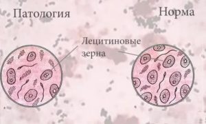 Что такое лецитиновые зерна в анализе секрета предстательной железы