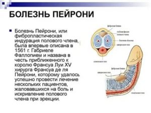 Какими препаратами лечить болезнь пейрони