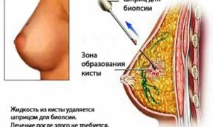 Могут ли рассосаться кисты в молочных железах при климаксе