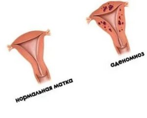 Как лечить эндометриоз матки в домашних условиях облепиховое масло