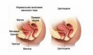 Препараты для лечения цистоцеле