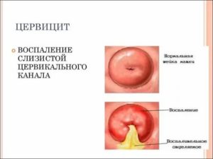 Эндометриоз шейки матки эндоцервицит
