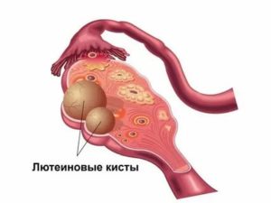 Что значит лютеиновая киста яичника