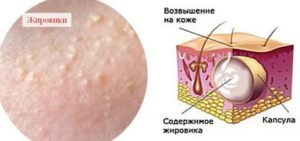 Мазь от жировиков на мошонке