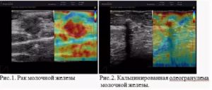 На какой день цикла делать узи молочных желез и щитовидной железы