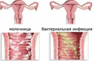 Как по научному называется молочница у женщин