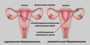 Могут ли идти месячные при отсутствии яичников