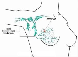 Лимфодиссекция при раке молочной железы это