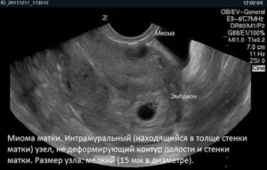 Можно ли на узи не увидеть миому матки на узи