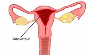 Тонкий эндометрий после отмены противозачаточных