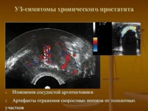 Эхографические признаки хронического простатита что это такое