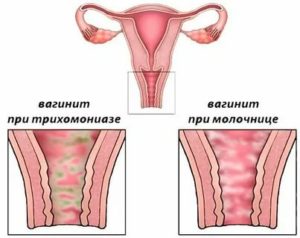 Санацию влагалища при беременности при молочнице