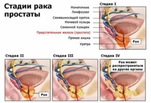 Что такое химическая кастрация при раке предстательной железы