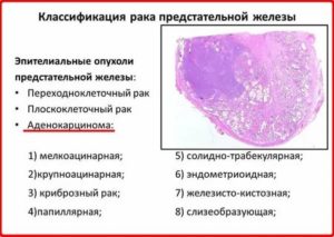 Что такое ацинарноклеточный рак предстательной железы