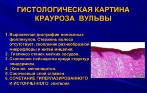 Препараты для лечения лейкоплакии вульвы