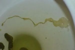 Молочница какать больно