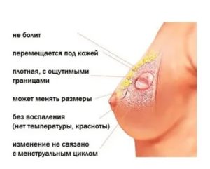 Аденома молочной железы препараты для лечения