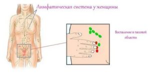 Могут ли увеличиваться паховые лимфоузлы во время месячных