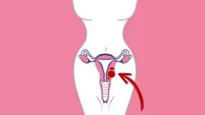 Можно ли при эндометриозе и миоме посещать баню