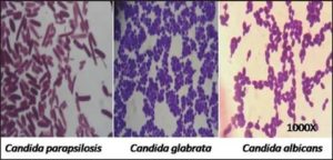 Candida spp при простатите