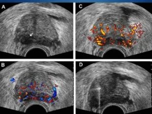 Эхографические признаки хронического простатита что это такое