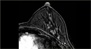 Мрт молочной железы с контрастом что показывает