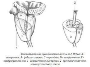 Что такое участки склероза предстательной железы