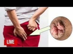 Молочница какать больно