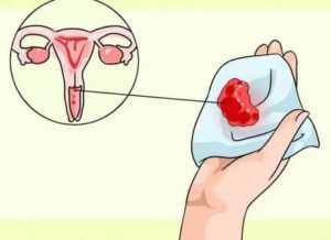 Может ли быть кровянистые выделения при кистах шейки матки