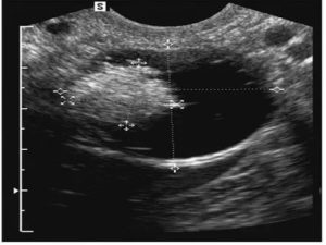 Текоматоз яичников на узи