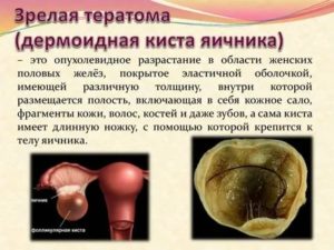 Что такое тератодермоидная киста правого яичника