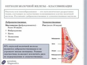 Могут ли быть уплотнения в молочной железе при климаксе