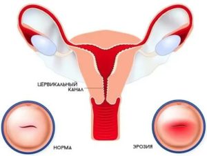Что такое эрозия шейки матки перед месячными