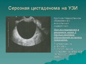 Что такое киста правого яичника папиллярная цистаденома