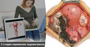 Эндометриоз 3 степени лечение отзывы