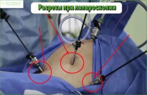 Препараты после лапароскопии маточных труб отзывы