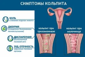 Как отличить молочницу от кольпита