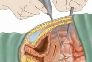 Задержка после лапароскопии эндометриоза