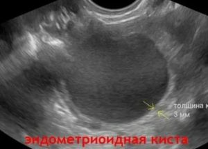 Что значит аваскулярная киста яичника