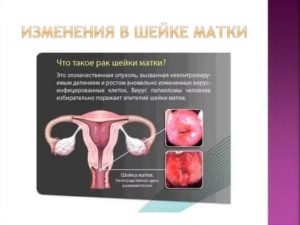 Что такое кистозное изменение шейки матки что это такое
