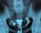 Что лучше узи или рентген на проходимость маточных труб