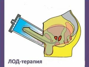 Что такое лод терапия при простатите