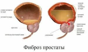 Фиброзные изменения предстательной железы что это такое лечение